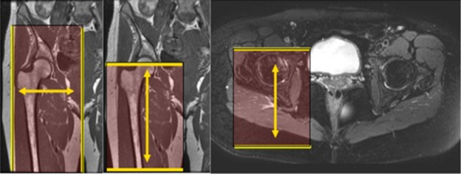 MRI Pelvis Hamstring WO MSK Protocol image