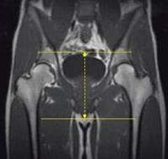 MRI Pelvis Sports Hernia WO MSK Protocol image 4