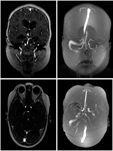 MRV Brain WO or WWO Neuroradiology Protocol