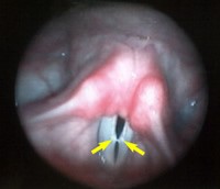 Vocal Fold Nodules