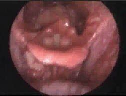 Spasmodic Dysphonia - VF