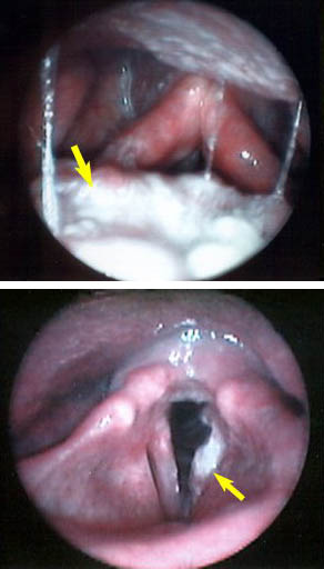 Laryngeal Cancer