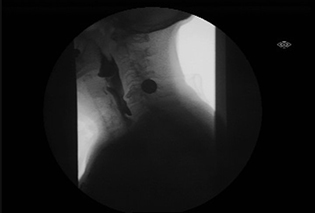 Zanker's Diverticulum Fluoro