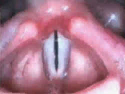 Normal Stroboscopic Exam