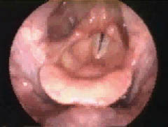 Vocal Folds After Botox
