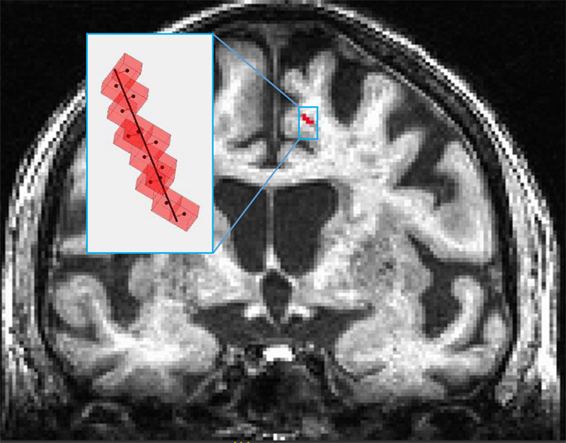 Brain image scan showing the automated technique to identify enlargement of the perivascular space using intensity thresholding and structural morphology