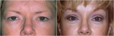 Image of before and after a forehead lift.