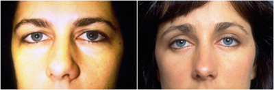 Forehead and brow lift image from the front before and after.