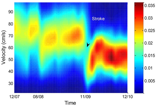A graph showing the change in walking speed of a study participant who had a stroke