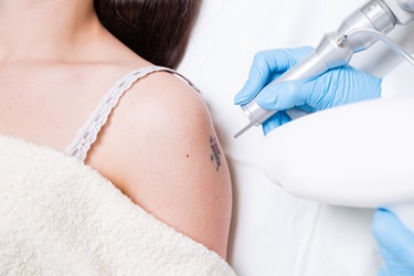 A woman getting a tattoo removed from her upper arm with a laser