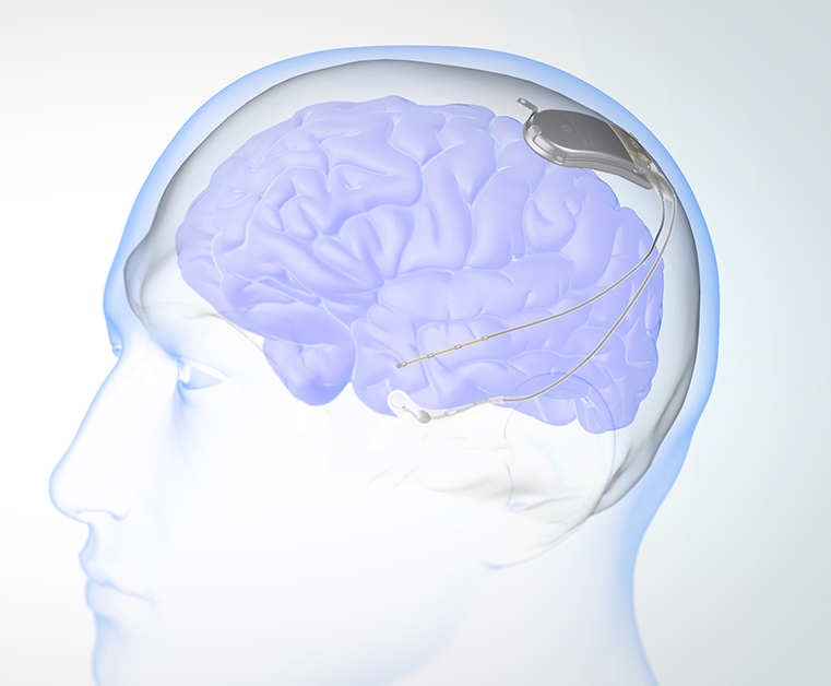 Courtesy of Neuropace. 博彩网站 researchers helped develop an implantable device that prevents or stops seizures - RNS, responsive neurostimulation
