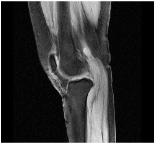MR MATERIALISE LOW-RES SAGITTAL KNEE FOR MRI TECHS