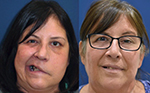 Jarmila Hawes facial reanimation surgery before and after