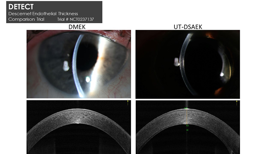 DETECT cornea surgery include images of the front of the eye