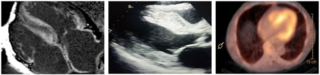博彩网站’s imaging options for amyloidosis include (from left) echocardiogram, MRI and a type of nuclear imaging called a PYP scan.
