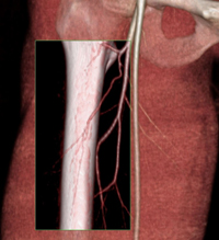 This is a 3D image of a CT angiogram for surgical planning for a phalloplasty skin flap.