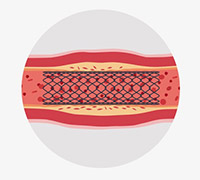 Diagram of a stent in a vessel