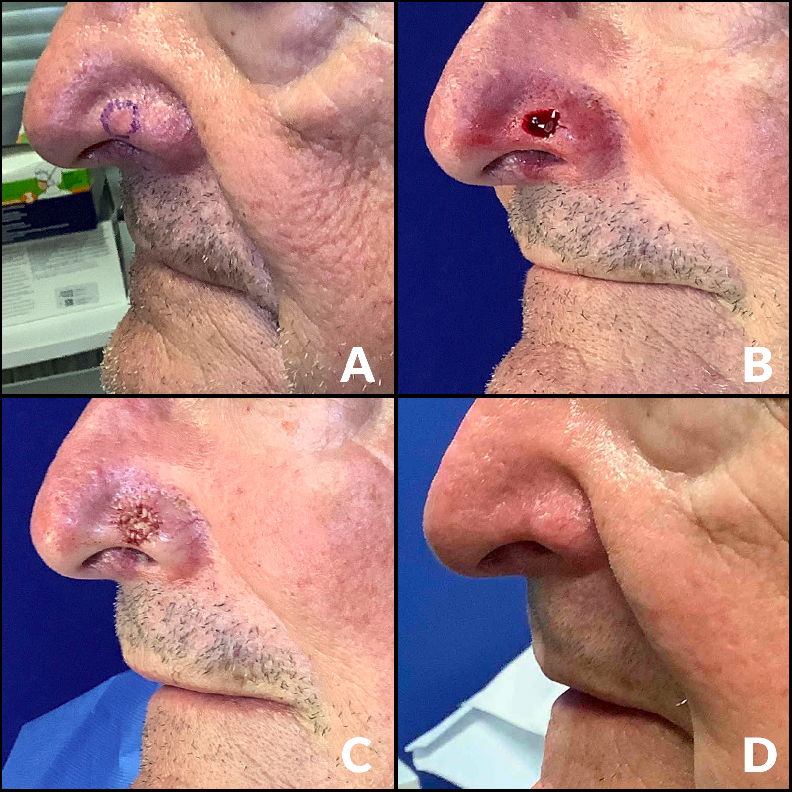 A comparison collage of images for a Mohs surgery patient