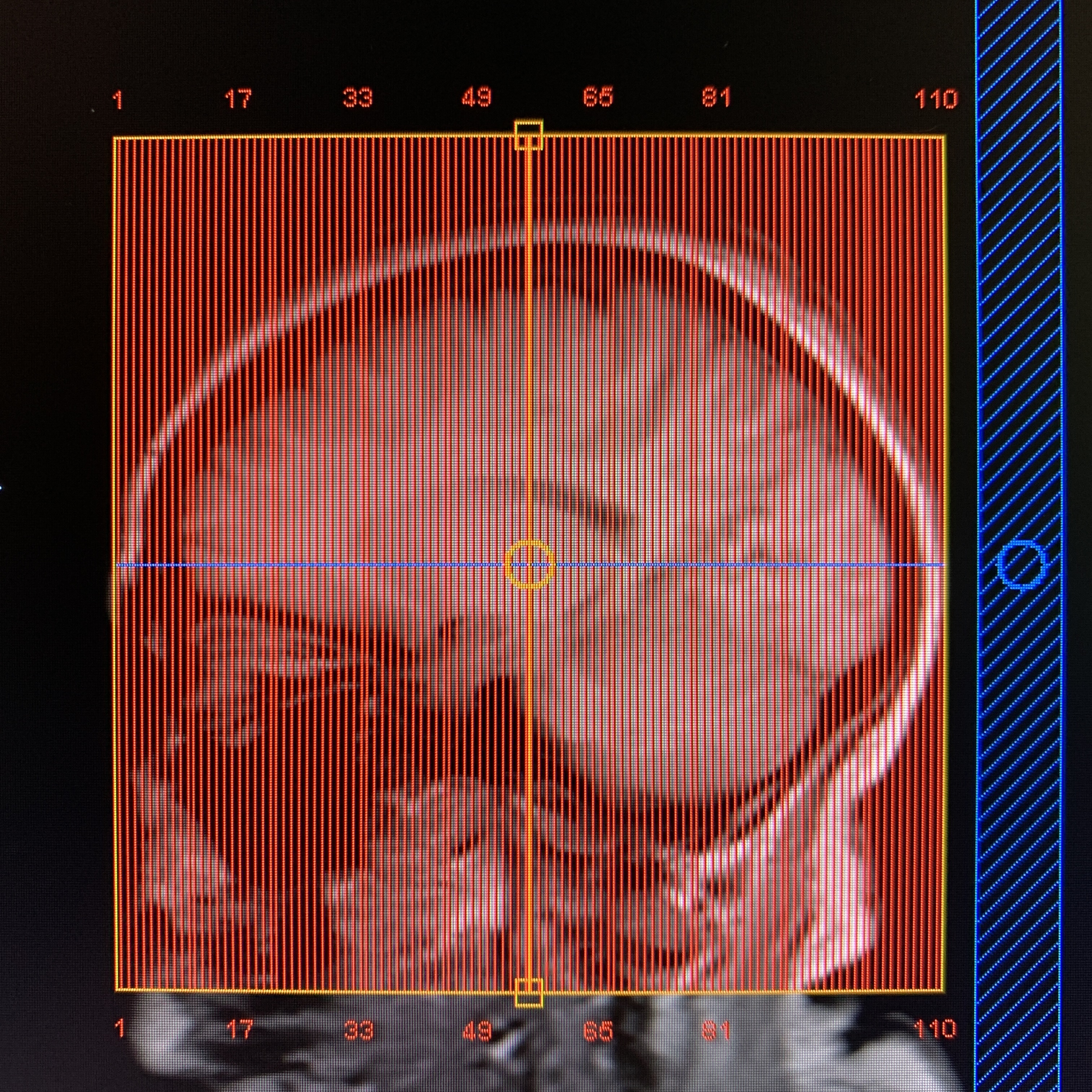MRV Coronal Planning for MRI technologists