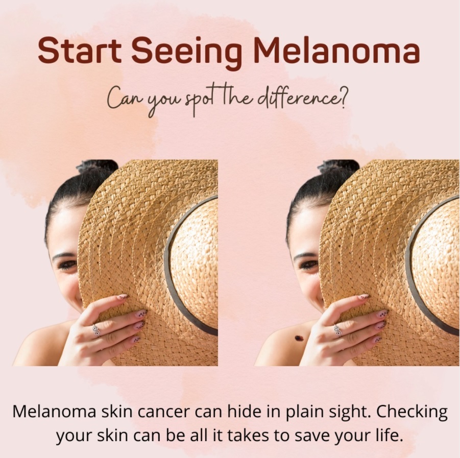 Two pictures of a woman with a hat side by side, with one side having a mole on her shoulder