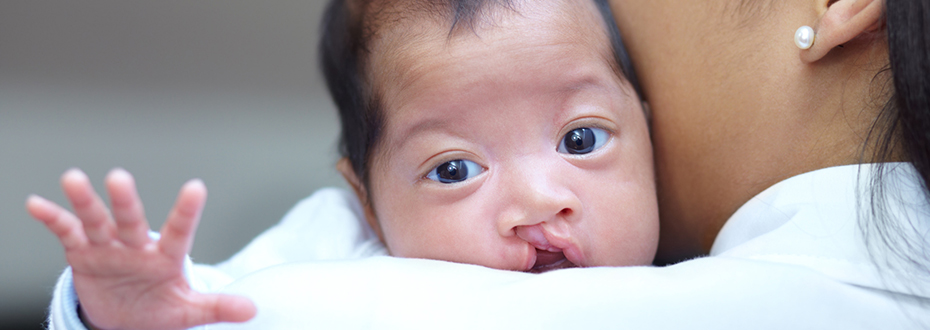 A baby with cleft lip looks ahead holding out their hand as a woman holds them to her chest.