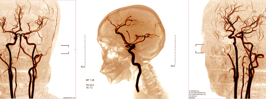 Scan images of blood vessels in the brain.