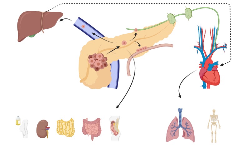 A diagram showing the avenues of metastasis from a primary pancreatic tumor including through the blood stream, lymphatic tissue, and perineural routes. Pancreatic cancer can disseminate to many different organs, but typically metastasizes to the liver or lungs.