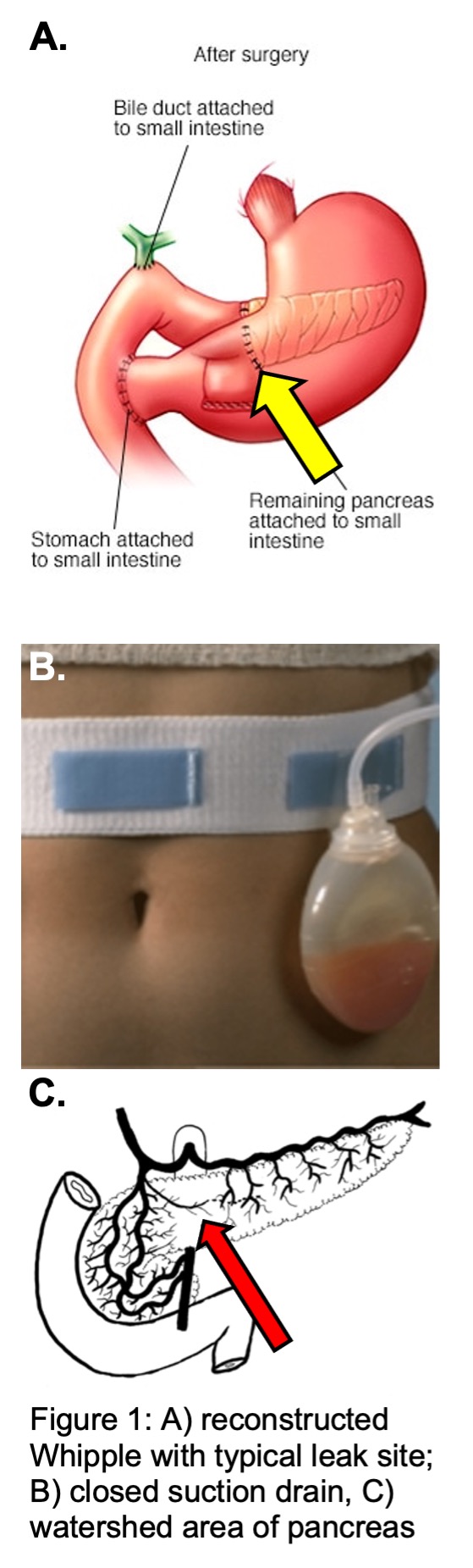 This image illustrates the reconstruction of the digestive tract after removal of the pancreatic head and illustrates the pancreatic anastomosis which can leak after surgery. A surgical drain demonstrating a pancreatic leak is depicted as is the blood supply to the pancreas which has a watershed zone that is poorly perfused and may contribute to postoperative pancreatic leaks.