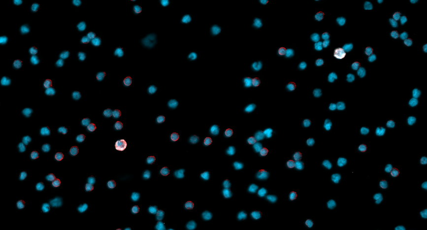 Image of microscopic circulating hybrid cells discovered at 博彩网站 that may detect who has eye cancer that spreads outside the eye.