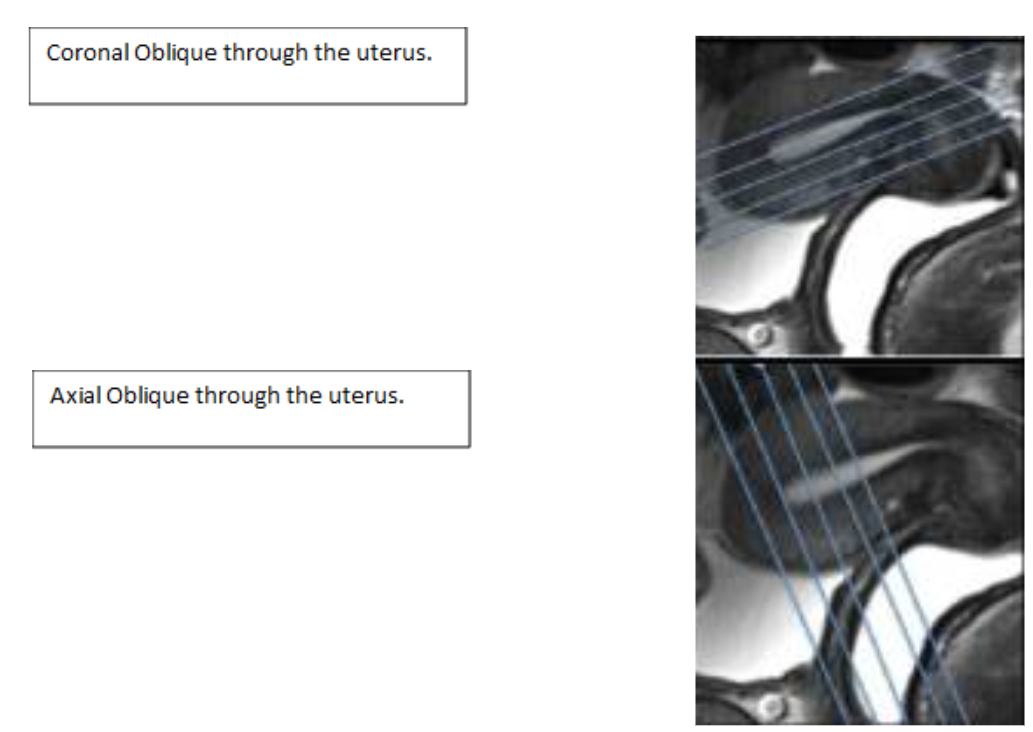Female Pelvis Congenital.PNG