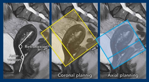 MRI Cervical CA Coverage Img 3