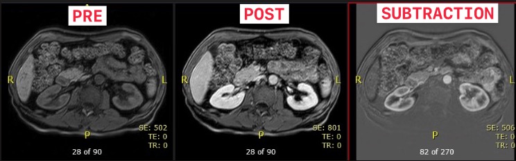 MRI Abd Pre Post Subtraction