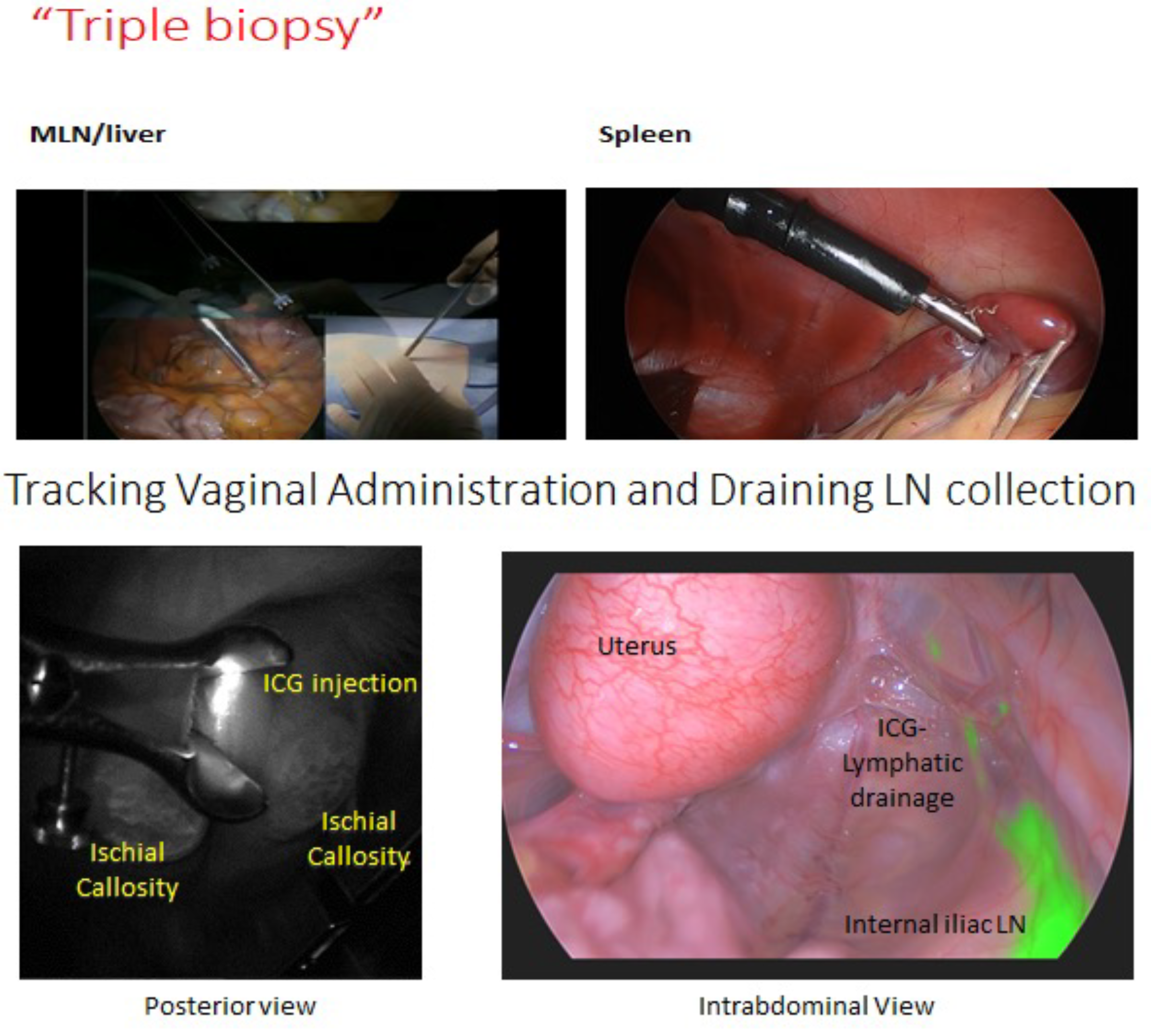 The second image represents the use of laparoscopic techniques to do minimally invasive biopsies of the spleen, mesenteric lymph nodes and liver. The final image is the use of ICG to identify the draining lymph node after an intraepithelial injection of ICG in the vaginal mucosa.