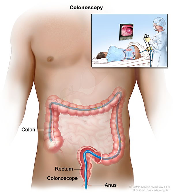 An illustration shows how a doctor guides a thin tube through the anus to inspect the rectum and colon. The sedated patient lies on their side. The colon makes an upside-down U shape. The tube travels vertically up the colon, horizontally as the colon travels across the upper belly, and back down to the lower belly.