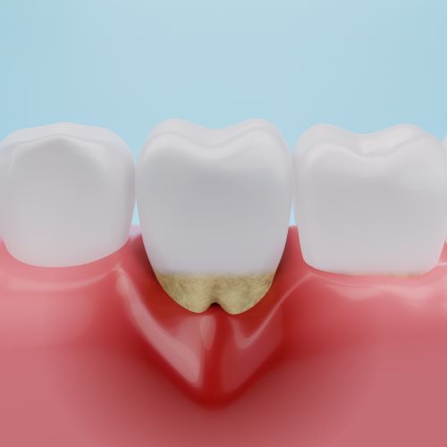 Color drawing of a secion of lower teeth. One tooth has red and puffy gums that is lower and exposing the root of the tooth.