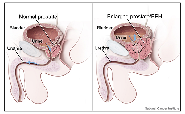 A drawing of a normal prostate shows the bladder, urethra, prostate and the flow of urine. A drawing of an enlarged prostate shows the bladder, urethra and how the growth of the prostate blocks the flow of urine.