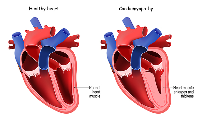 An illustration of cross-sections of two hearts next to each other. On the left is a healthy heart, showing a normal heart muscle. On the right is a heart with cardiomyopathy, showing a heart muscle that is enlarged and thickened.