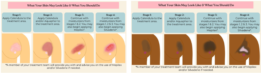 Infographic of skin reactions to radiation therapy treatment for breast cancer