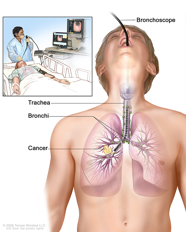 An illustration shows how a doctor places a bronchoscope in a patient’s lung with the help of digital imaging.