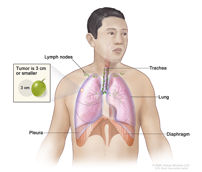 A drawing shows a tumor in a person’s lung and compares the tumor’s size to a grape.