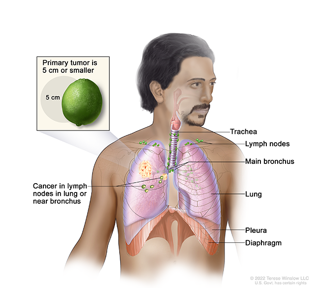 A drawing shows a tumor in a person’s lung and cancer in lymph nodes. A detail drawing compares the tumor size to a lime labeled 5 centimeters.