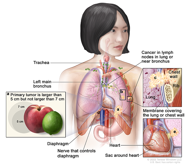 A drawing shows cancer in a lung and nearby lymph nodes. A detail drawing compares the tumor size to a lime labeled 5 centimeters and a peach labeled 7 centimeters. A second detail drawing shows cancer in the chest wall. A third detail drawing shows cancer in a chest membrane.