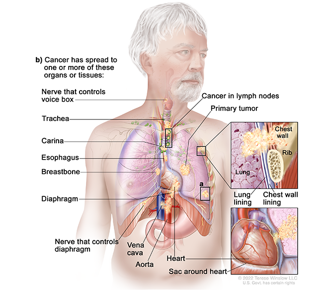A drawing shows cancer throughout the chest. A detail drawing shows cancer in the chest wall. A second detail drawing shows cancer in the heart.