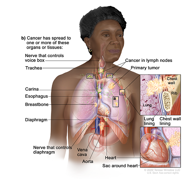A drawing shows cancer throughout the chest. A detail drawing shows cancer in the chest wall. A second detail drawing shows cancer in the heart.