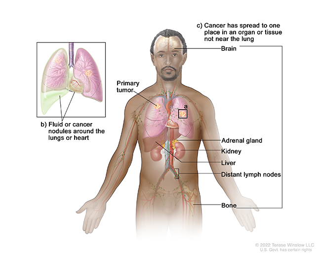 A drawing shows cancer that has spread outside the lung. A detail drawing shows fluid or cancer nodules around the lungs or heart.