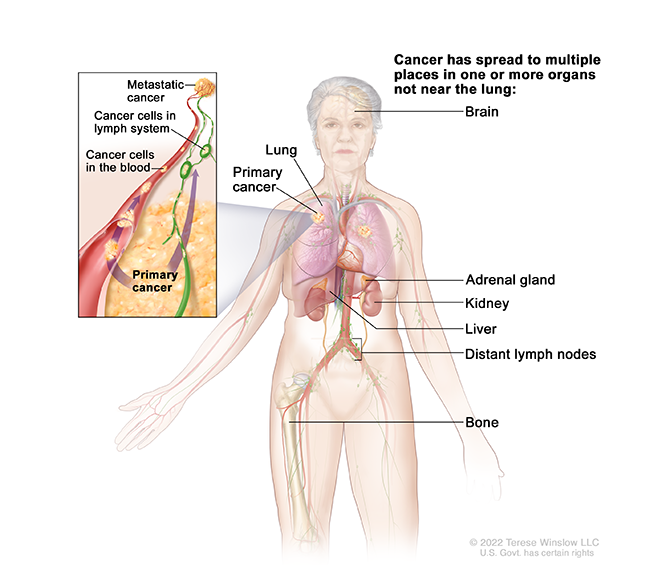 A drawing shows cancer throughout the body. A detailed drawing shows cancer in the blood and lymph vessels.
