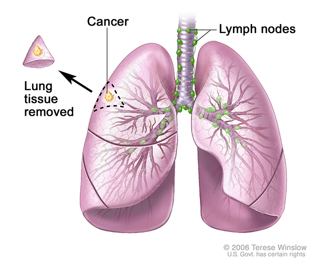 An illustration shows the trachea (windpipe) and lungs with cancer in a lung lobe. The removed lung tissue with the cancer and small amount of healthy tissue around it is shown next to the lung lobe it was removed from.